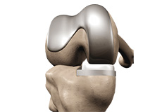 ConforMIS® Knee