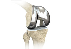 Custom - fitted Total Knee Arthroplasty