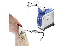 Robotic Assisted Partial Knee Replacement