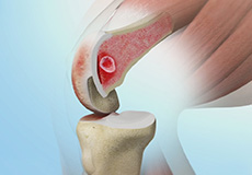 Subchondroplasty