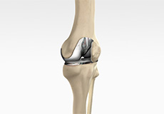Minimally or Less Invasive Total Knee Arthroplasty