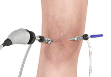 Knee Arthroscopy