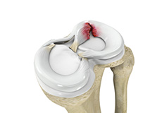 Meniscal Tears