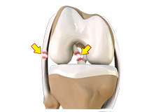 Multi Ligament Reconstruction