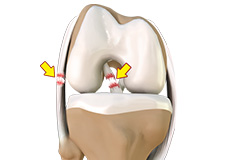 Multiligament Instability