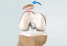 Patellar Dislocation/Patellofemoral Dislocation